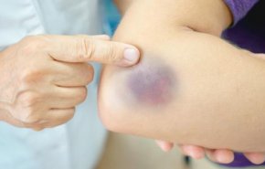 ظهور كدمات مفاجئة على جلدك تنذرك بمشاكل صحية خطيرة‎