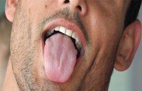 متى يكشف لسانك اصابتك بامراض القلب؟