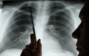 دراسة مثيرة للقلق: كورونا قد يثقب رئة المريض..وهذه هي الأعراض