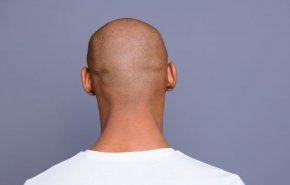 لهذا السبب.. الرجال الصلع أكثر عرضة للاصابة بكورونا!
