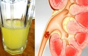 طرق طبيعية بسيطة للتخلص من حصوات الكلى 