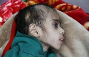 صور صادمة لطفل يمني عمره 7 سنوات ووزنه 7كغم