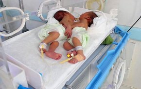 اليونيسف توافق على نقل التوأم السيامي للعلاج الى الخارج