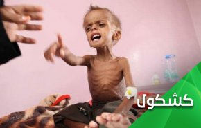 المجاعة اخر اسلحة المهزومون في اليمن 
