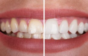 ما هي اسباب وطرق علاج اصفرار الاسنان المختلفة؟