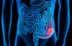 4 نصائح للوقایة من سرطان القولون