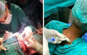 عملية جراحية هي الاولى سوريا والـ11 عالمياً