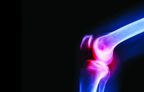 تقنية جديدة لعلاج التهاب المفاصل بشعاع ليزر يحفز الخلايا الجذعية