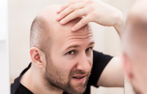 اكتشاف علاج طبيعي يقضي على الصلع