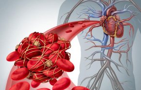دراسة تحدد سبب تشكّل جلطات الدم لدى المصابين بـ