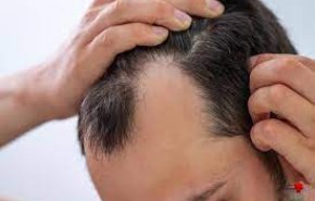 طرق استعادة الشعر بعد الاصابة بكورونا