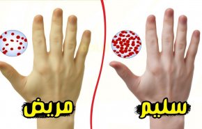 'فقر الدم'.. أسباب وأعراض الإصابة به!
