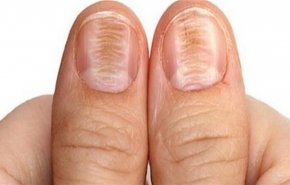 تغير لون الأظافر ينذر بالتسمم أو تليف الكبد 
