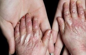 انتاج جلد صناعي في ايران للاستخدامات الطبية