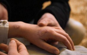 الصحة العالمية: تسجيل 131 حالة لجدري القردة في 17 دولة

