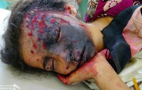 مخلفات والغام تحالف العدوان لا تزال تفتك بالشعب اليمني