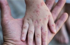 الصحة العالمية تعلن إصابة أكثر من 5 آلاف بجدري القردة في العالم