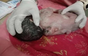  ظاهرة طبية نادرة للغاية في الهند.. طفل رضيع بهذه المواصفات!