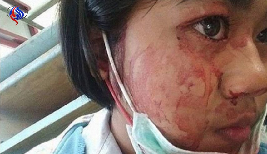 حالة مرضية تجعل شابة تتعرق دما !