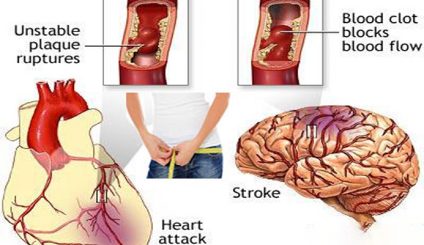 تراكم الدهون في هذه المناطق من الجسم يسبب الموت
