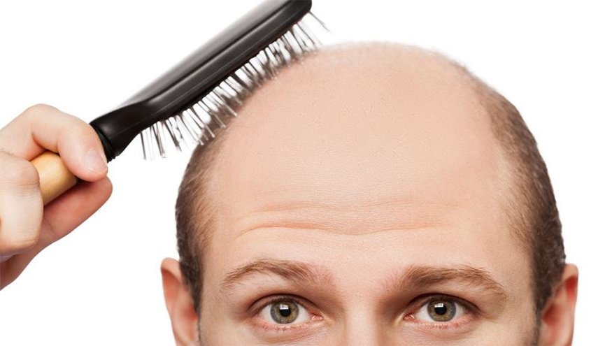 وداعا للصلع... اكتشاف مادة عطرية تعزز نمو الشعر