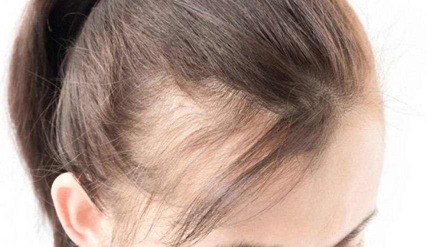 6 بدائل طبيعية لمحاربة تساقط الشعر!