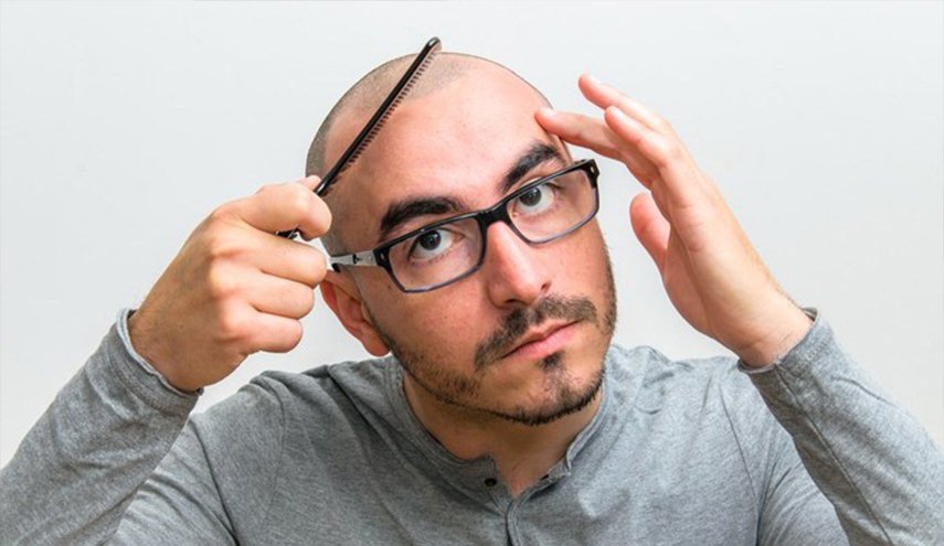 هذا هو علاج الصلع الوراثي