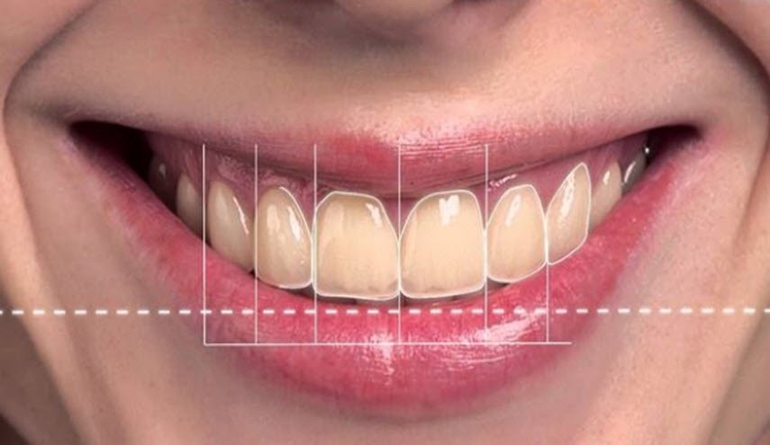 ما هو التصميم الرقمي للابتسامة؟ 