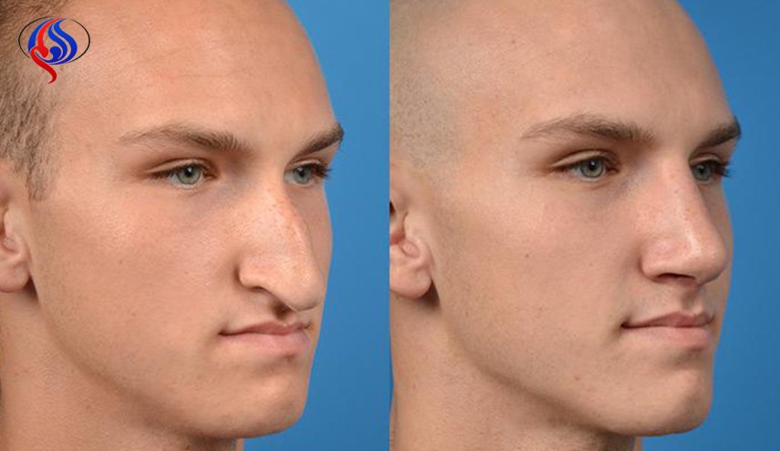 تقنية مذهلة لتجميل الأنف خلال 5 دقائق ودون جراحة!