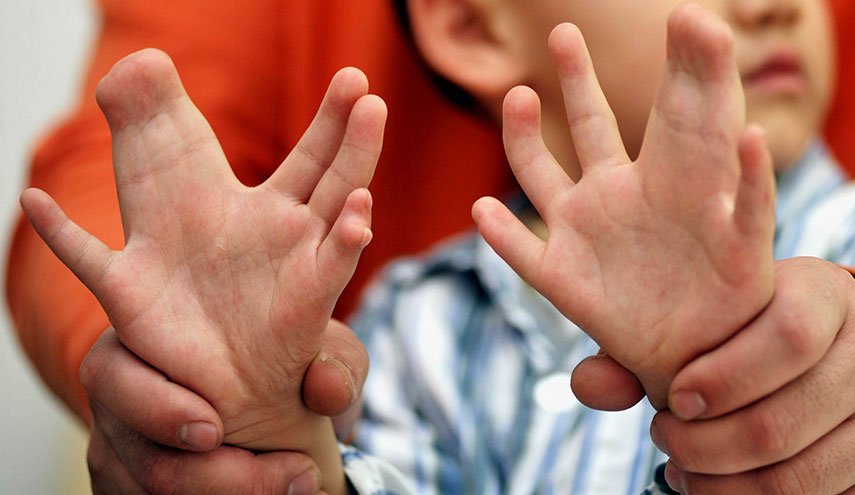 عملية جراحیة ناجحة لإزالة الأصابع الزائدة في يدي طفلة
