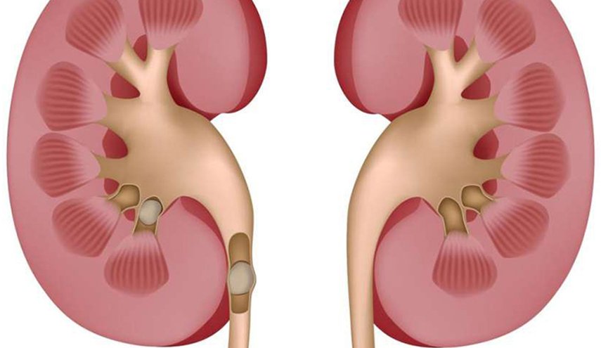 علاج حصى الكلى بـ 8 وصفات منزلية سهلة جداً 