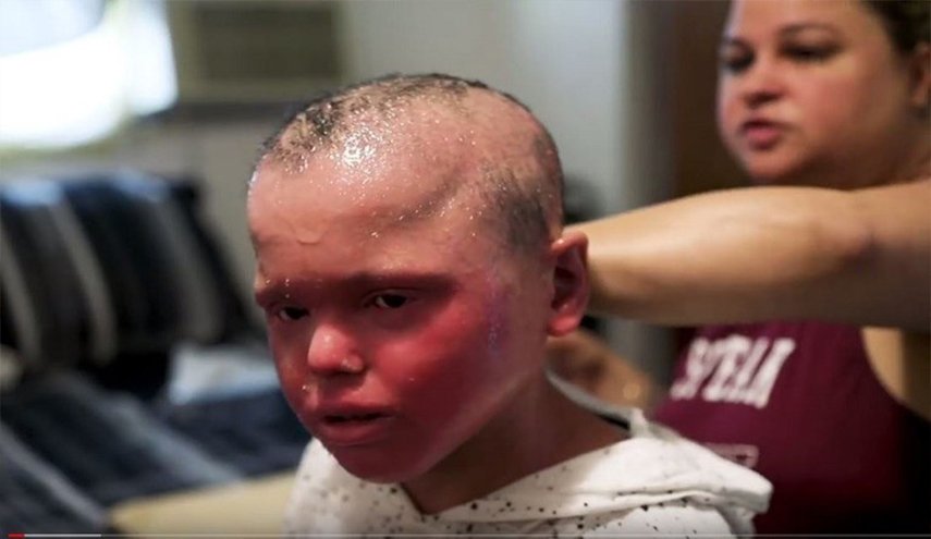 صبي يخلع جلده كالأفعى