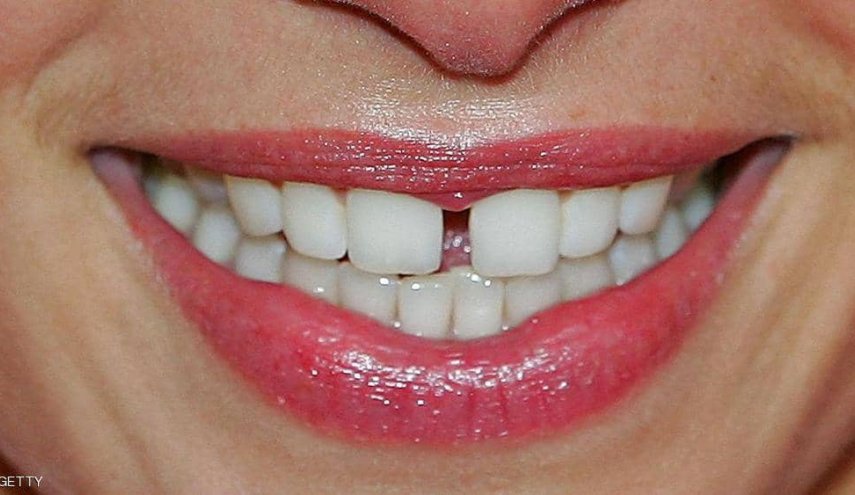 إزالة جير الأسنان.. 10 طرق طبيعية تجعلك اسنانك كاللآلئ