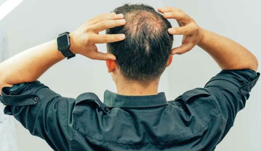 الكشف عن علاج بسيط وفعال لمشكلة الصلع