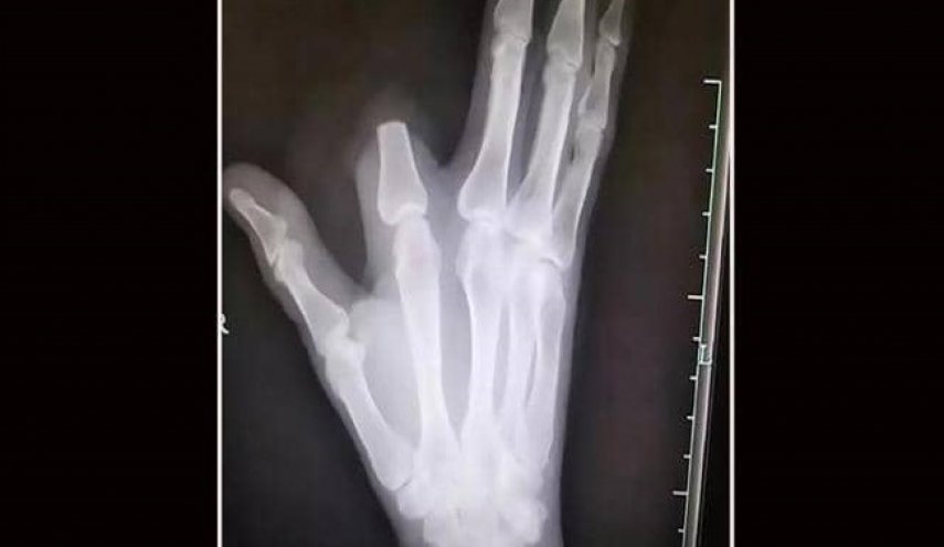قطع إصبعه بسبب لدغة أفعى..ثم اكتشف 