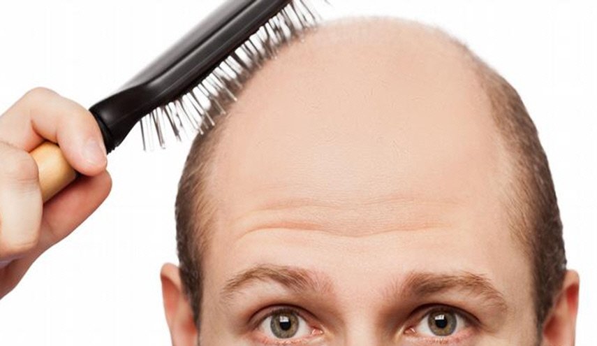 هل من علاج للصلع؟.. نعم وهذه المرة حقيقي
