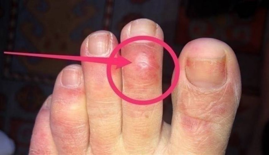 راقب هذه العلامة المبكرة لكورونا على قدم الأطفال!