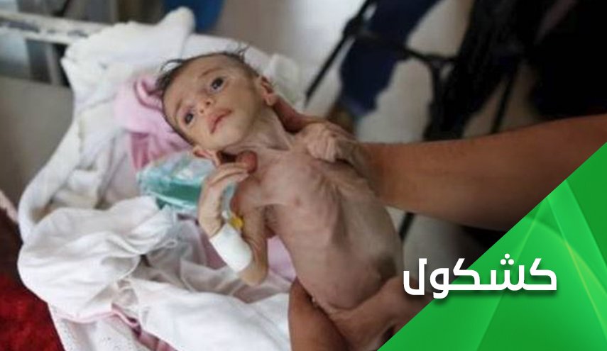 إذا أردت أن تعرف نفاق العالم فانظر الى أطفال اليمن

