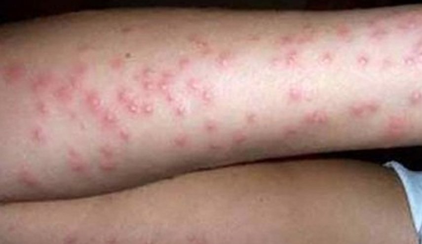 ابتلای بیش از ۶ هزار چینی به تب مالت به دنبال نشست این باکتری از یک کارخانه