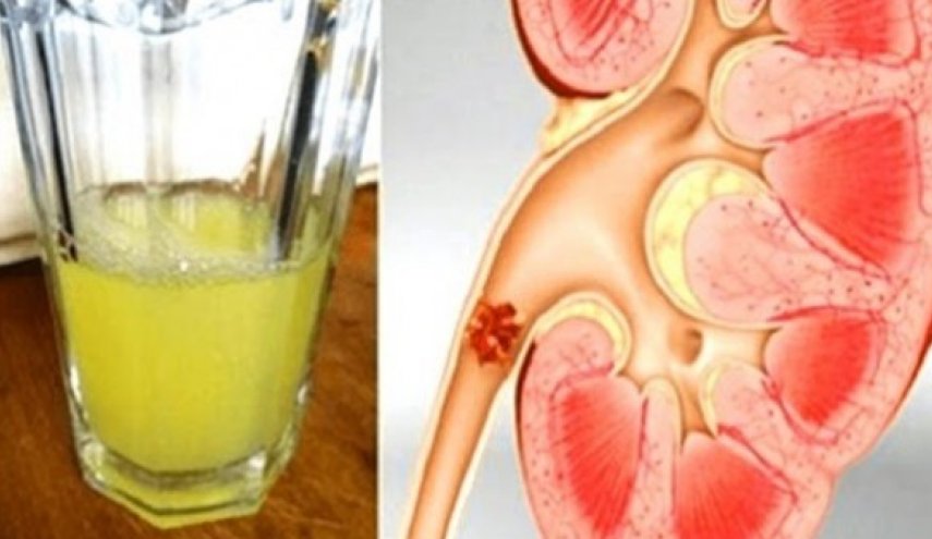 طرق طبيعية بسيطة للتخلص من حصوات الكلى 
