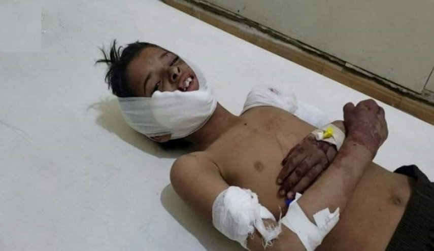 إصابة طفل يمني بانفجار قنبلة من مخلفات العدوان السعودي