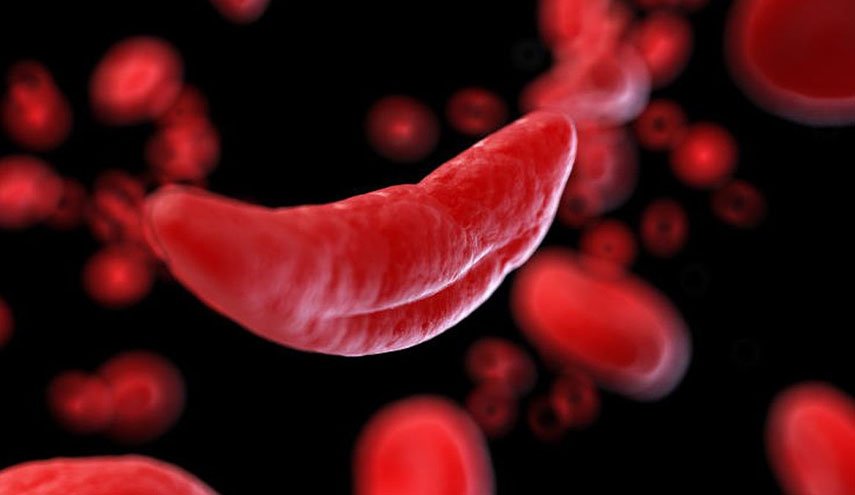 استهداف الخلايا المنجلية قد يساعد في علاج 