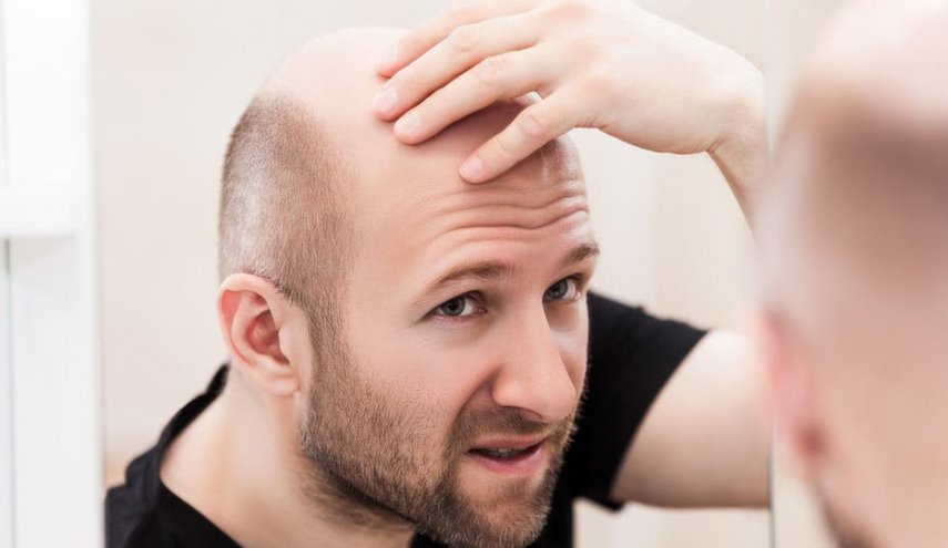 اكتشاف علاج طبيعي يقضي على الصلع