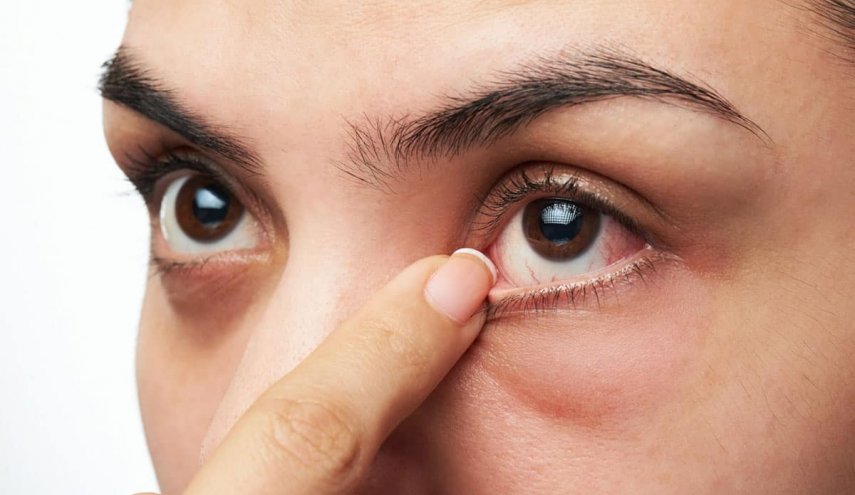 طرق بسيطة وفعالة للتخلص من انتفاخ العينين