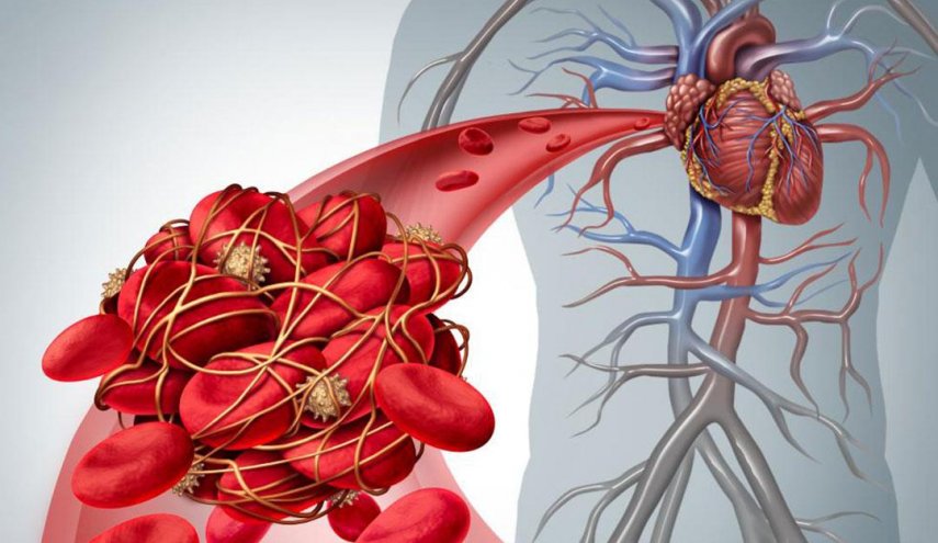 دراسة تحدد سبب تشكّل جلطات الدم لدى المصابين بـ