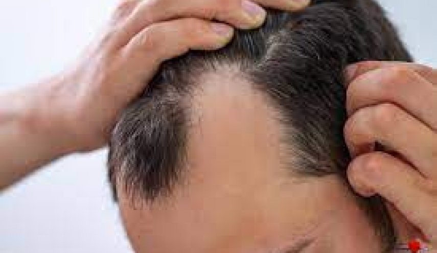 طرق استعادة الشعر بعد الاصابة بكورونا