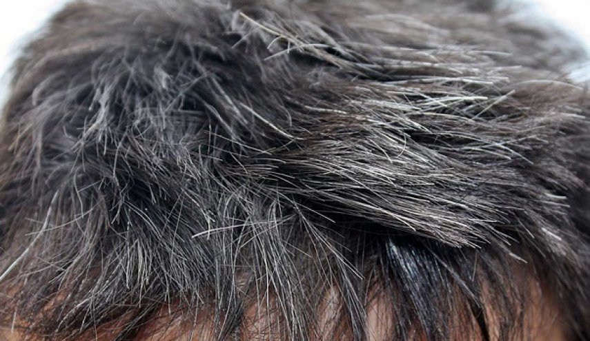 فيتامين يسبب نقصه شيب الشعر والحل؟