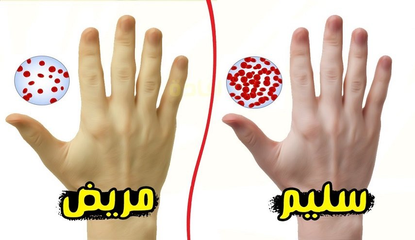 'فقر الدم'.. أسباب وأعراض الإصابة به!
