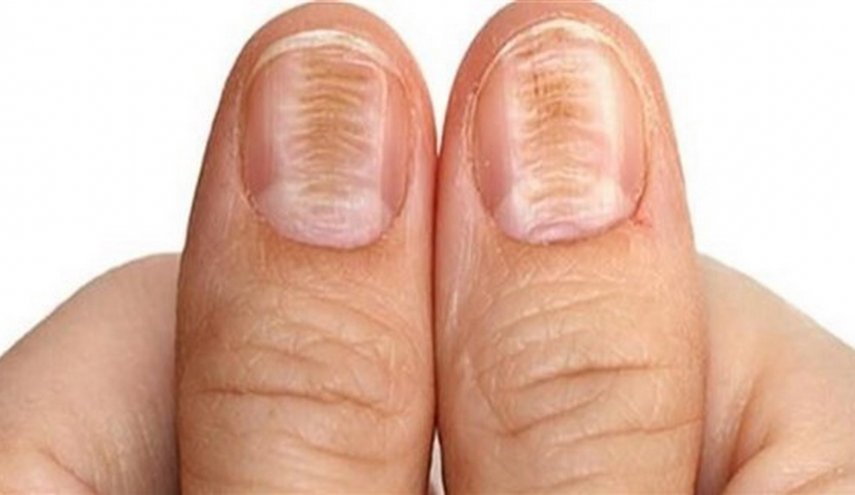 تغير لون الأظافر ينذر بالتسمم أو تليف الكبد 