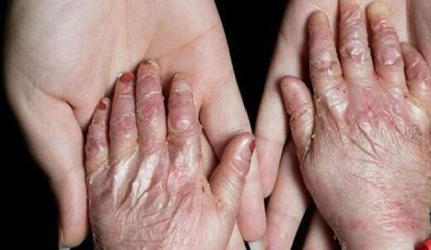 انتاج جلد صناعي في ايران للاستخدامات الطبية